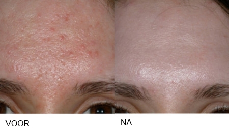 Peave China Potentieel Lasertherapie acne bij Huidinstituut Versailles