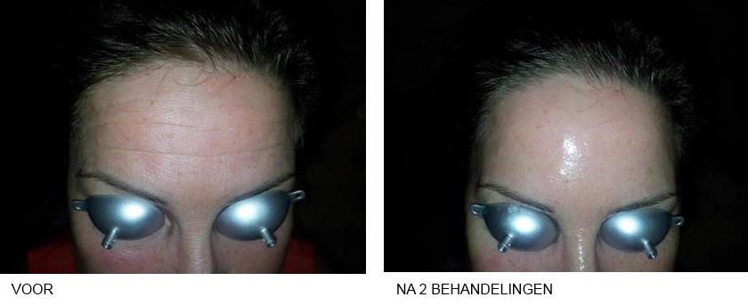 facelift voor en na